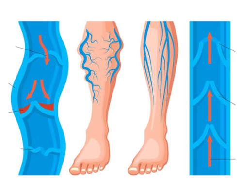 behandling af åreknuder på ben